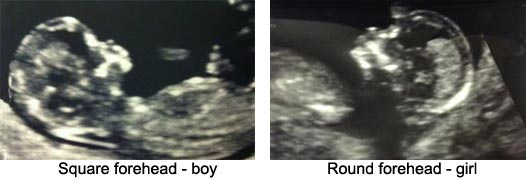 photo of 20 week old fetus